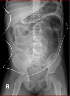 Case Report: A rare instance of acute appendicitis induced by Balantidium Coli parasitic infection